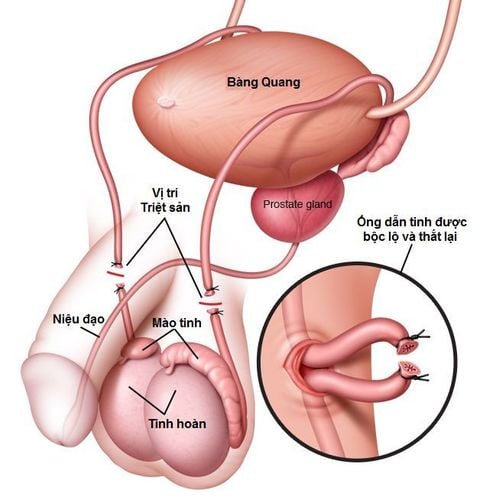 Thắt ống dẫn tinh là phương pháp triệt sản ở nam giới. 