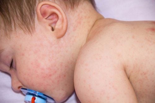 Trẻ bị sốt và nổi mẩn ngứa điều trị thế nào?