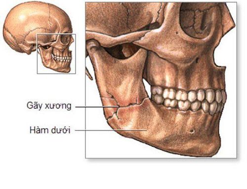 
Hình ảnh gãy xương hàm dưới
