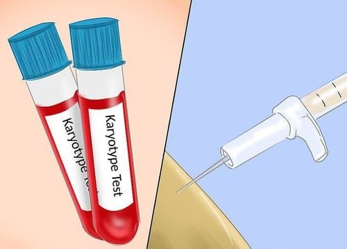 
Karyotype hay còn gọi là xét nghiệm nhiễm sắc thể đồ
