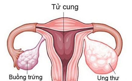 
Hình ảnh ung thư buồng trứng
