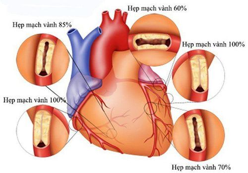 
Bệnh hẹp đông mạch vành
