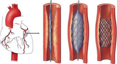 
Can thiệp đặt stent động mạch vành điều trị hẹp tắc mạch vành
