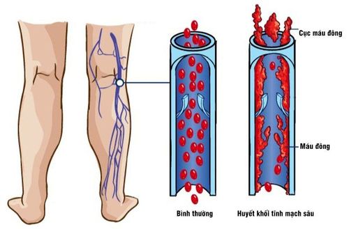 What is deep vein thrombosis? Causes, warning symptoms