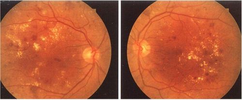 What is retinopathy? What are the common types?