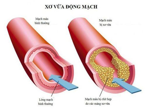 
Xơ vữa gây tắc động mạch ngoại biên
