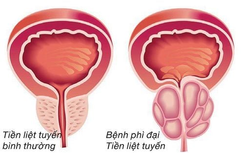 Normal size of the prostate