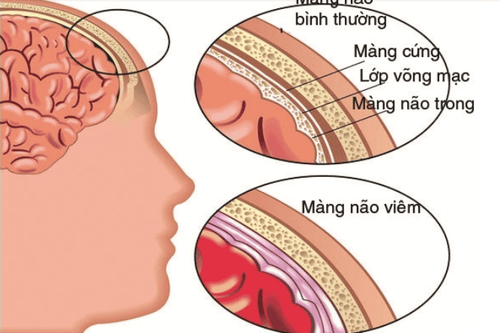 
Một biến chứng nguy hiểm của bệnh giang mai là viêm màng não
