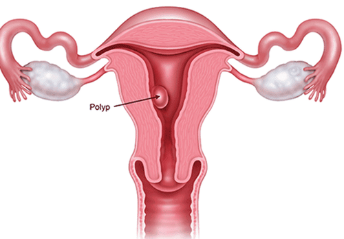 Are uterine polyps dangerous?