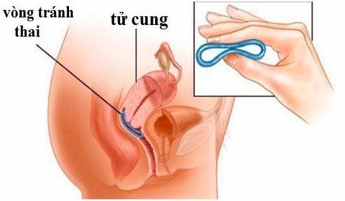 
Biện pháp tránh thai bằng đặt vòng
