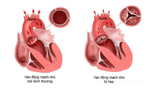 Động mạch chủ bình thường và hẹp van động mạch chủ