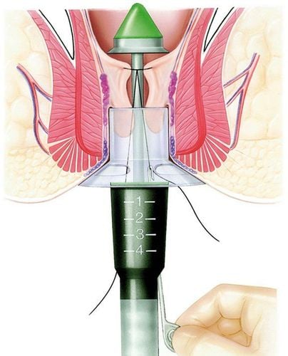 
Bộ dụng cụ cho phẫu thuật Longo
