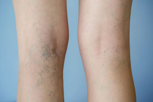 What is venous insufficiency? Is it dangerous?