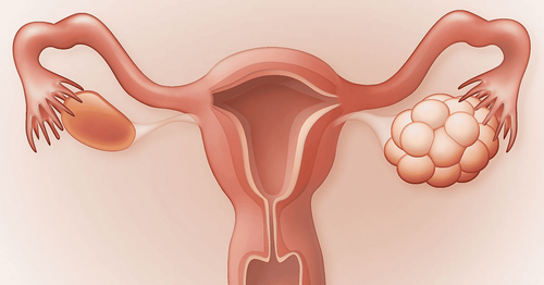 Irregular menstruation - manifestation of polycystic ovary?