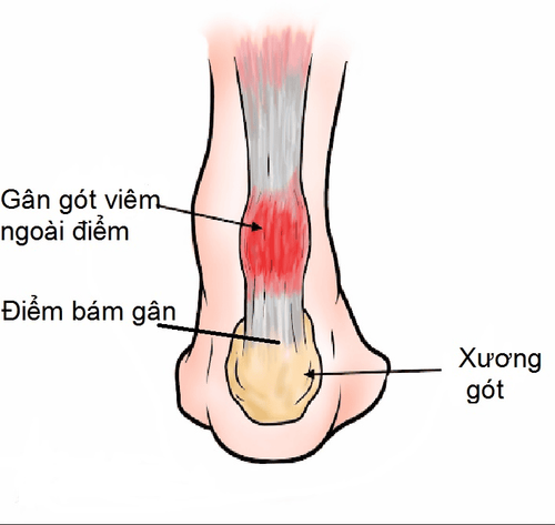 
Viêm điểm bám gân gây ảnh hưởng nhiều tới chất lượng cuộc sống của bệnh nhân
