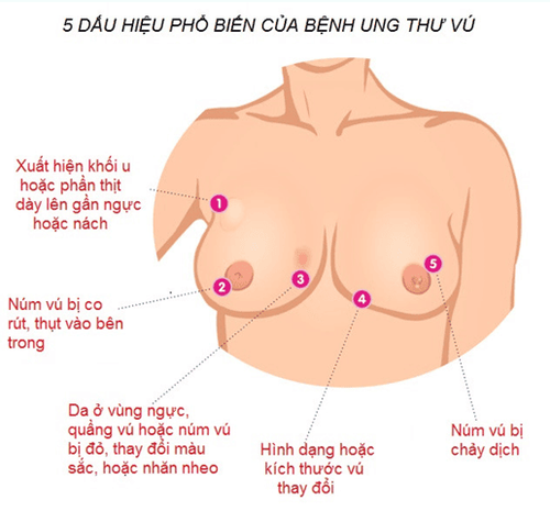 
5 dấu hiệu phổ biến của ung thư vú.
