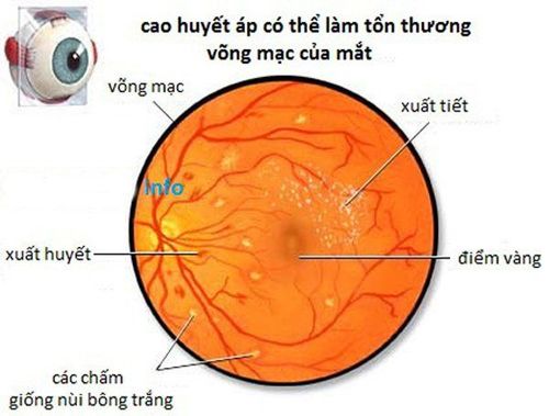 
Biến chứng thường gặp của cao huyết áp là bệnh võng mạc
