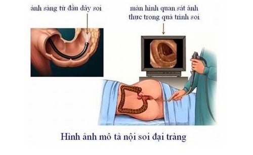 Sau khi nội soi dạ dày đại tràng nên ăn gì và kiêng gì?