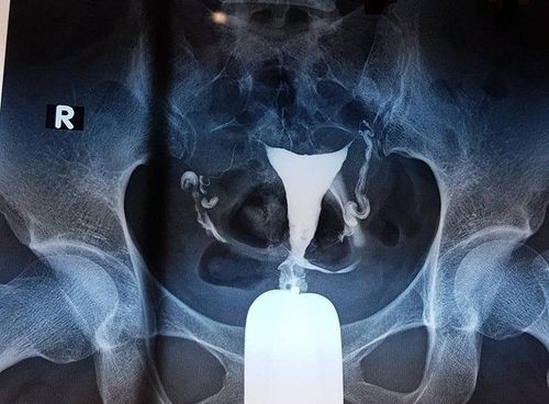 X-ray of the uterus and fallopian tubes (HSG scan) in which case?