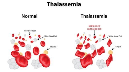 Có thể phát hiện nguy cơ mắc Thalassemia ở trẻ nếu xét nghiệm gen trước khi mang thai