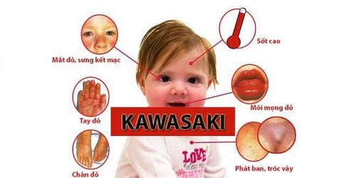 
Một số biểu hiện của trẻ khi bị Kawasaki
