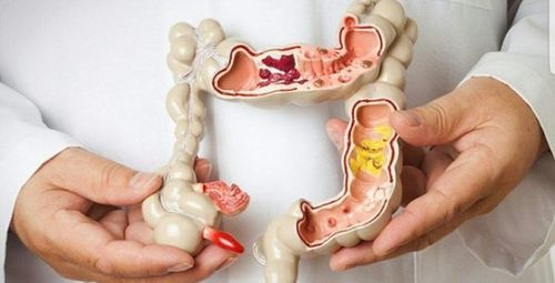 Measures to diagnose colon cancer