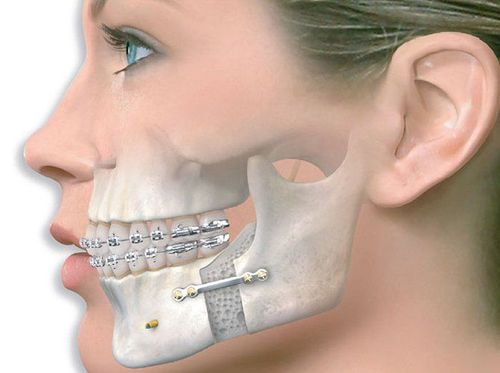 The procedure of facial computed tomography with contrast injection in the axial and coronal planes