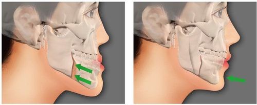 The procedure of computed tomography of the face without contrast injection in the axial and coronal planes