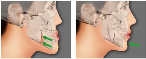 Methods of treatment of facial fractures