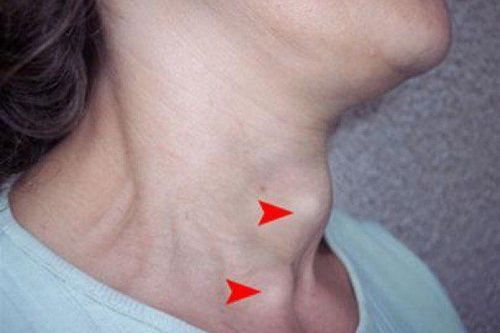 Is goiter, basedow dangerous?