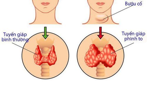 
Basedow là bệnh rất nguy hiểm cho hệ tim mạch
