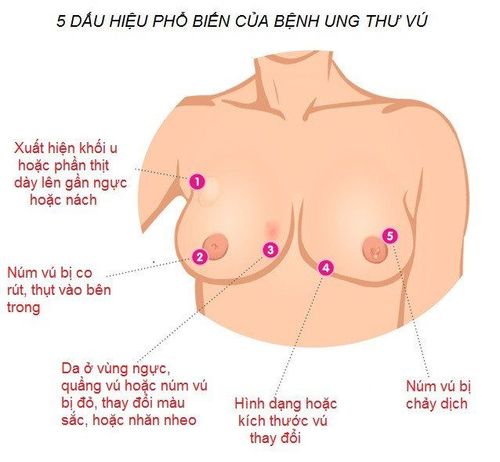 
Một vài biểu hiện của bệnh ung thư vú
