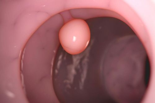 Are polyps cancerous?