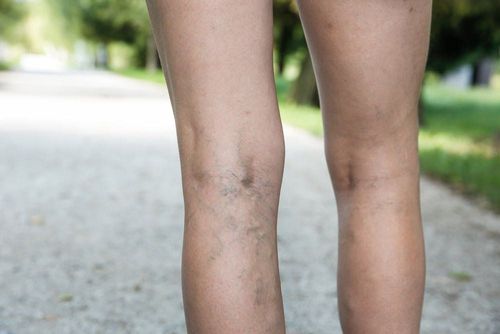 Varicose veins: What you need to know