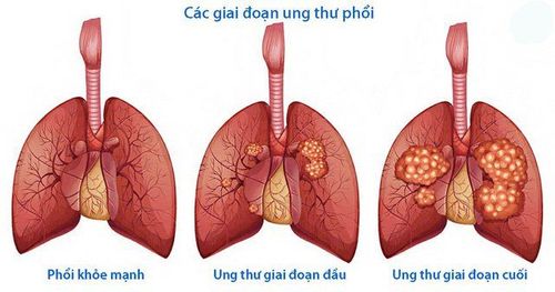 
Khoảng một phần ba bệnh nhân ung thư phổi được chẩn đoán mắc bệnh còn khu trú tại chỗ có thể được điều trị bằng phẫu thuật cắt bỏ
