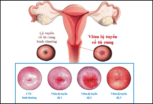 Đang chữa viêm lộ tuyến có tiêm được vắc xin HPV ngừa ung thư cổ tử cung không?