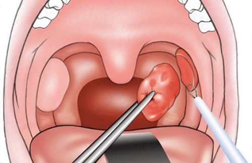 Dredging VA, cutting tonsils