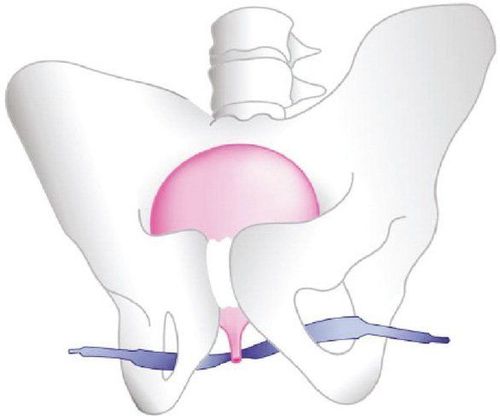 
T.O.T - Đặt dải băng nâng đỡ niệu đạo qua 2 lỗ bịt
