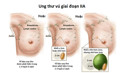 Lựa chọn điều trị ung thư vú ở giai đoạn 4