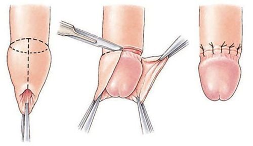 
Trường hợp chưa cắt bao quy đầu hãy kéo bao quy đầu lại trước khi đeo bao cao su
