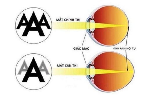 
Do sự bất thường của hệ thống khúc xạ, hình ảnh của vật không được hội tụ nằm trên võng mạc mà bị hội tụ nằm trước võng mạc dẫn đến nhìn mờ
