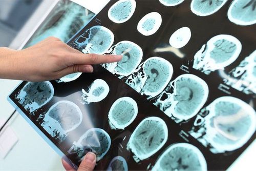 Giá trị của PET, PET/CT, CT và MRI trong chẩn đoán bệnh Alzheimer