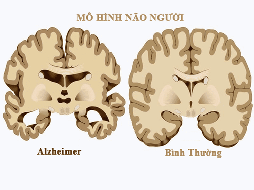 Bệnh Alzheimer có thể khiến người bệnh mất trí nhớ và suy giảm khả năng tư duy nghiêm trọng
