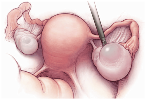 How to treat ovarian cysts at Vinmec