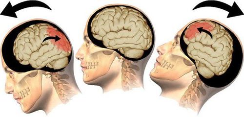 
Khi có một tác động lên đầu, phá vỡ chức năng bình thường của não sẽ gây ra chấn thương sọ não
