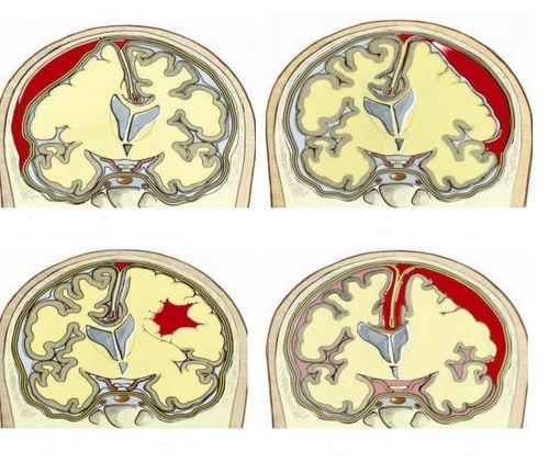 Traumatic brain injury: How to recognize and treat?