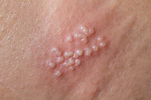 
Virus HSV1 xâm nhập làm xuất hiện những mụn nước nhỏ li ti trên da
