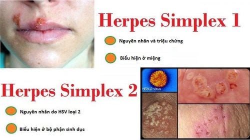 
Virus Herpes Simplex gây mụn rộp sinh dục ở các vị trí khác nhau
