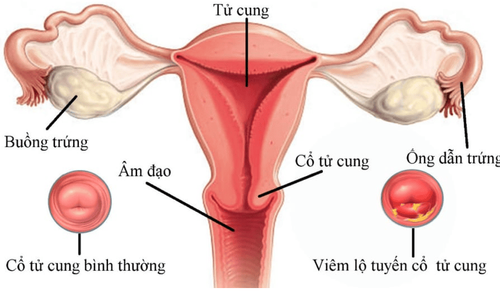 Methods to cure cervical ectropion