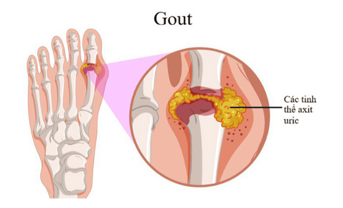 
Người tiêu thụ quá nhiều protein có thể gặp tình trạng bệnh gout
